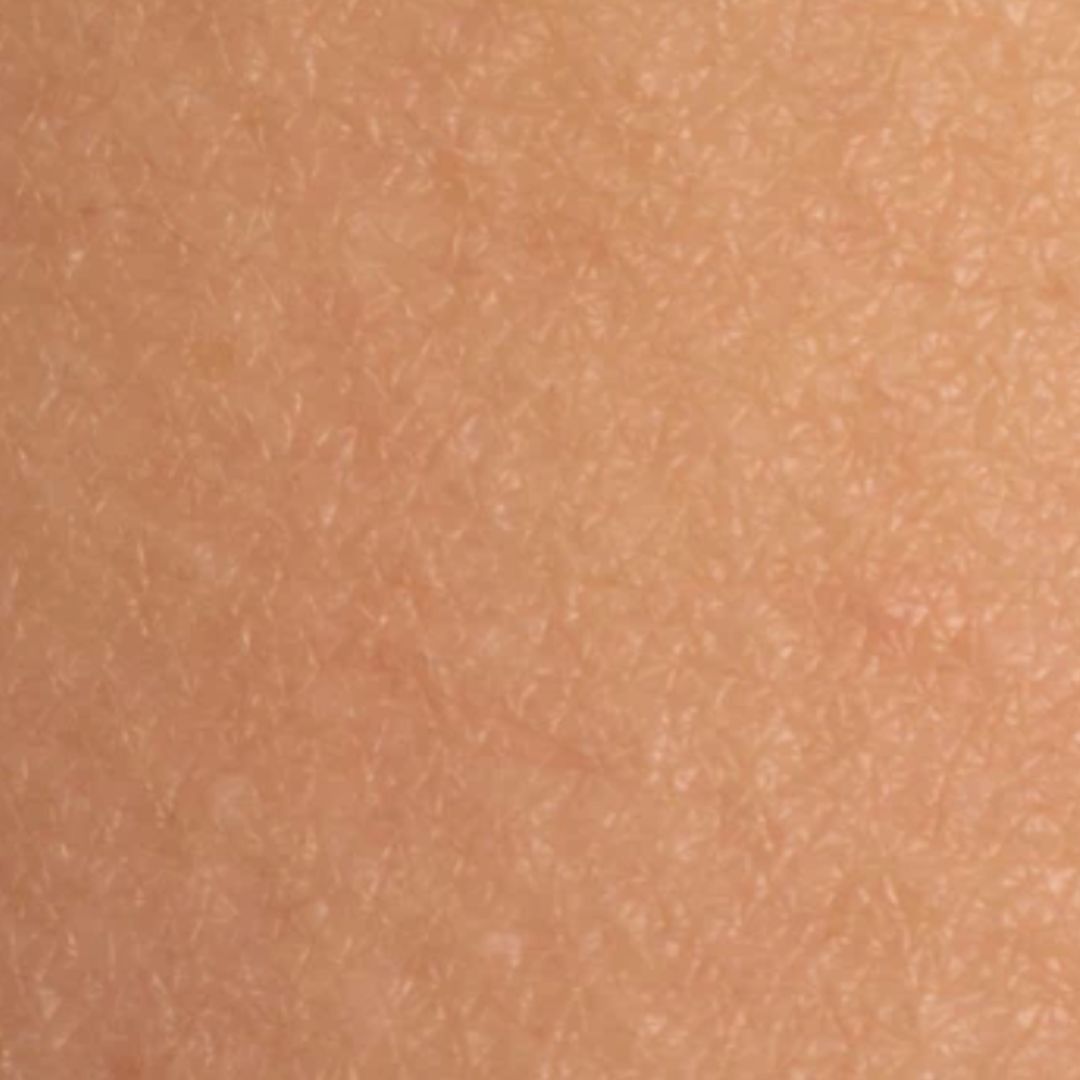 apres épilation définitive (14)