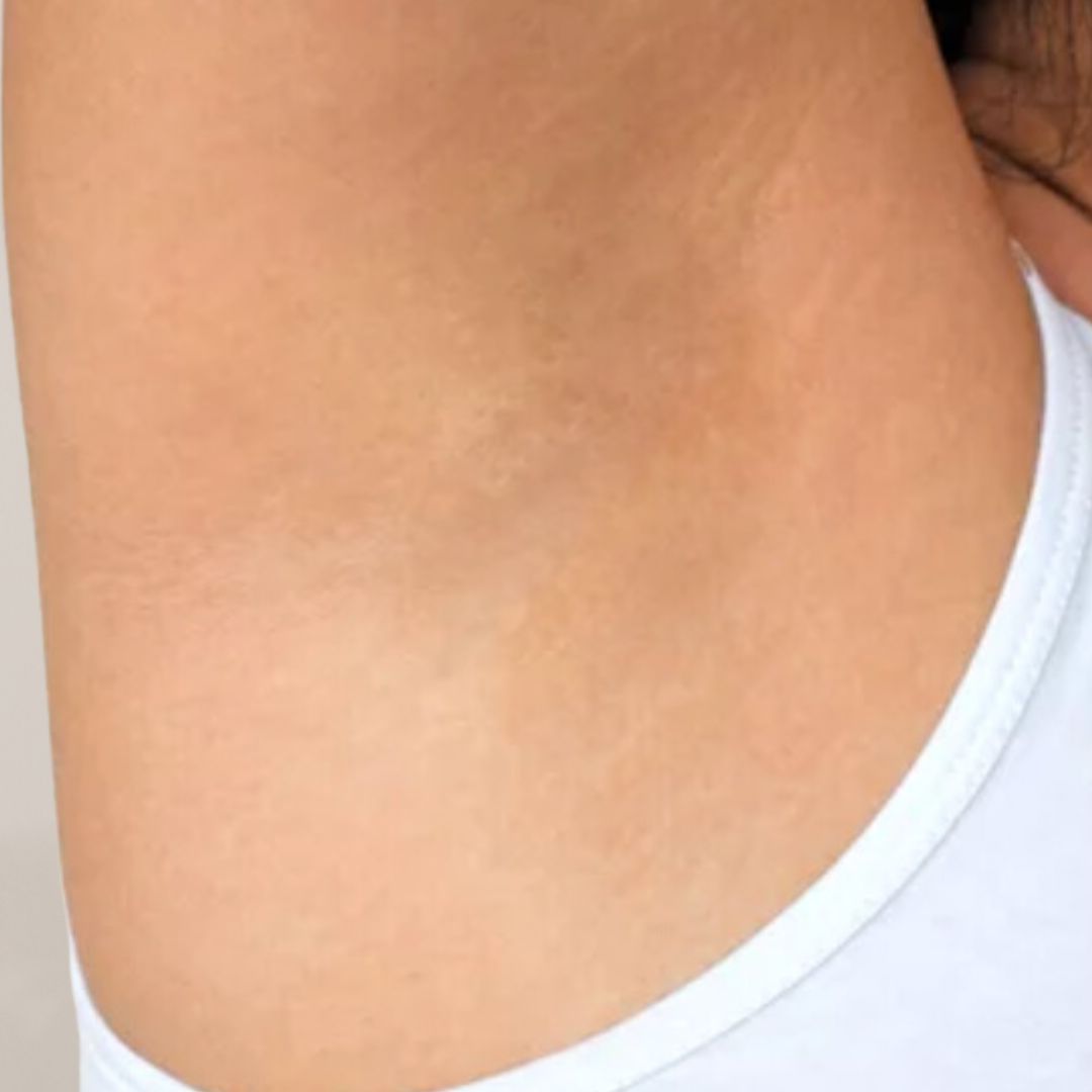 apres épilation définitive (22)