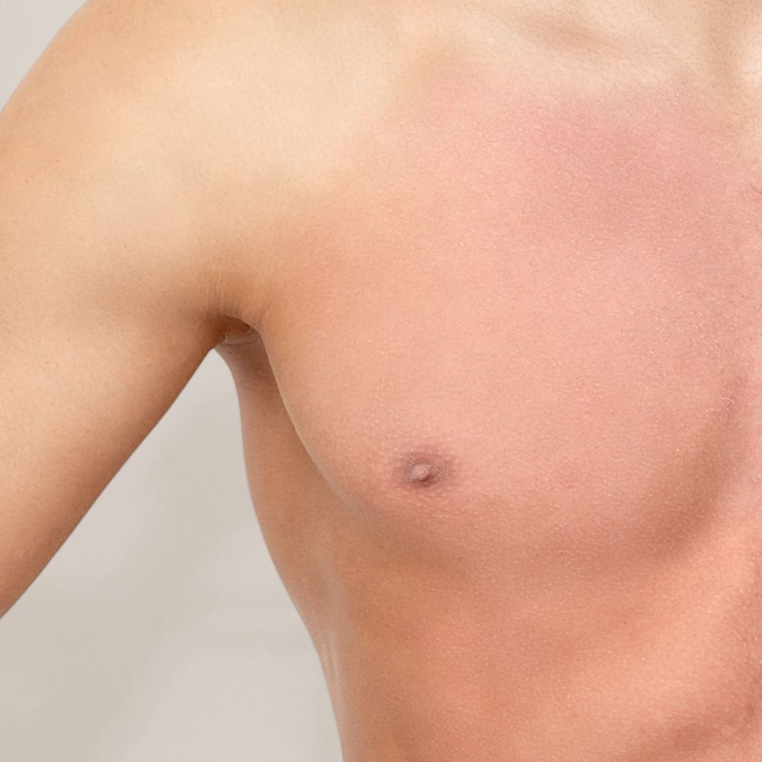 apres épilation définitive (3)