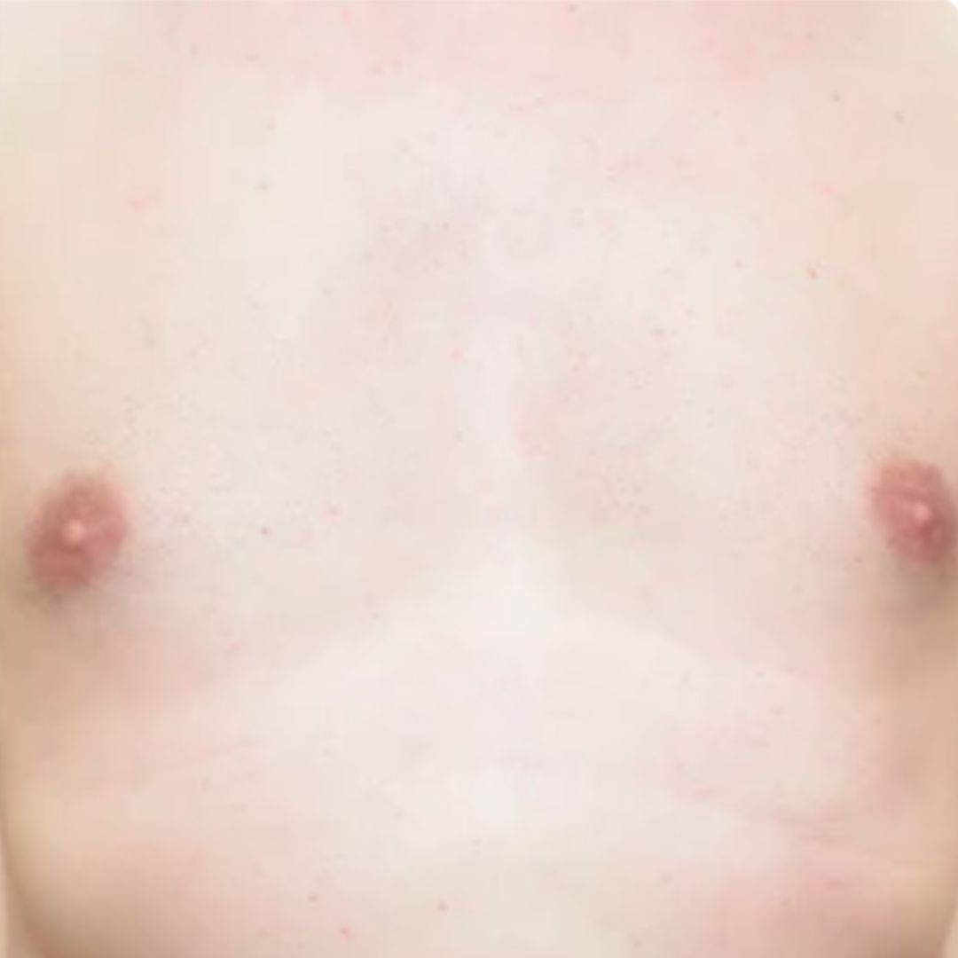 apres épilation définitive (5)