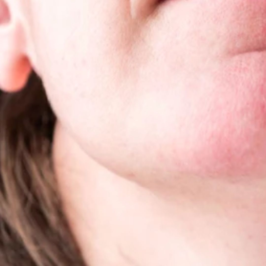 apres épilation définitive (6)