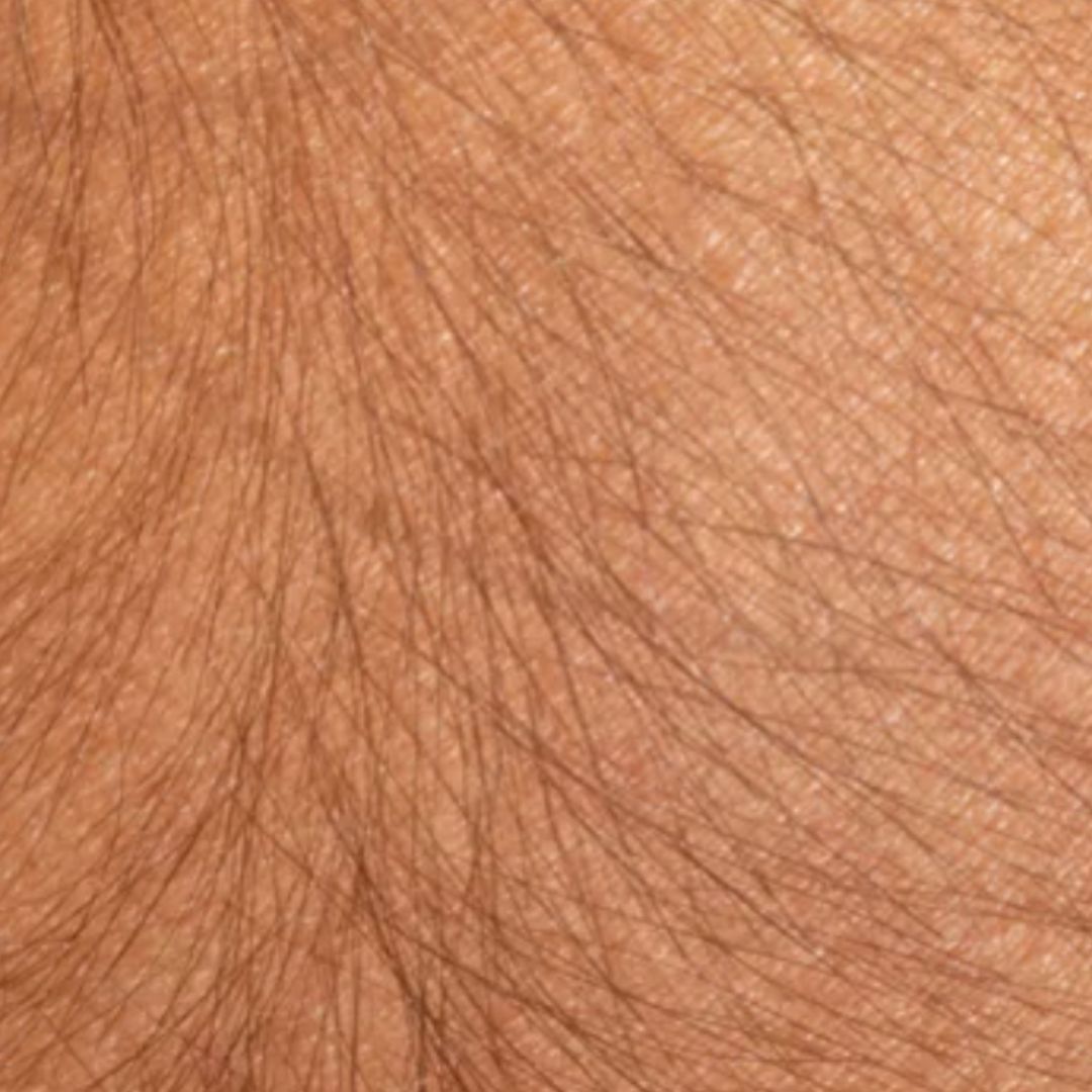 avant épilation définitive (16)