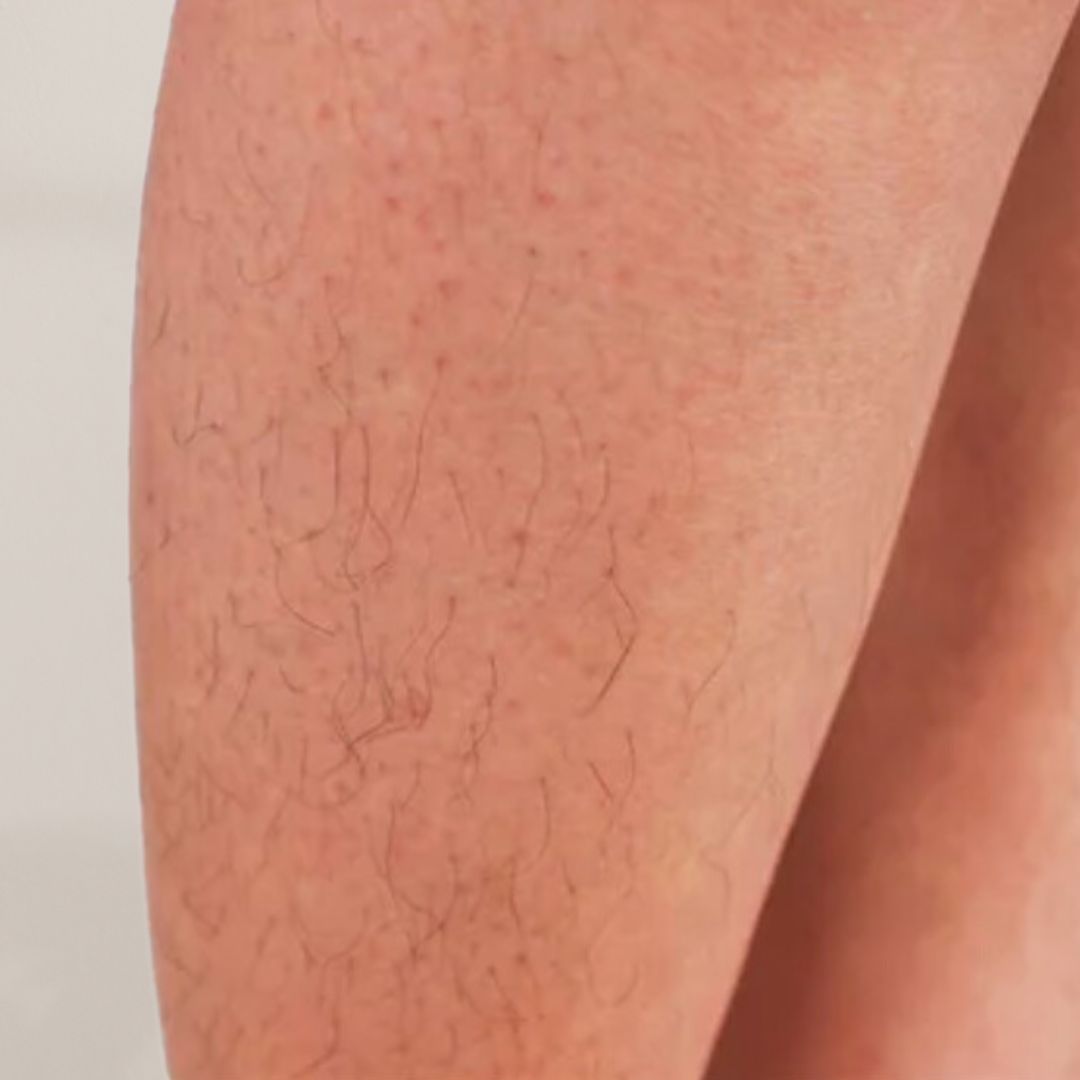 avant épilation définitive (23)