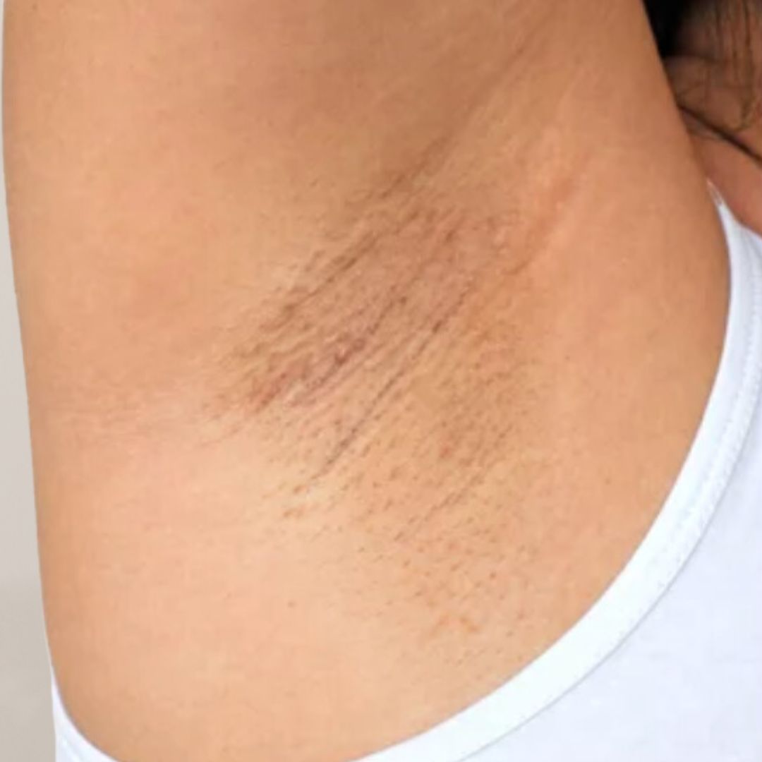 avant épilation définitive (24)