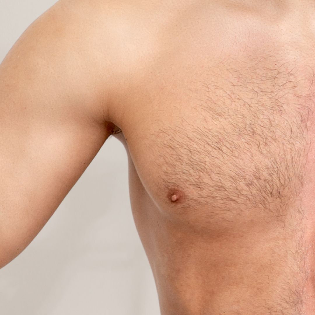 avant épilation définitive (3)