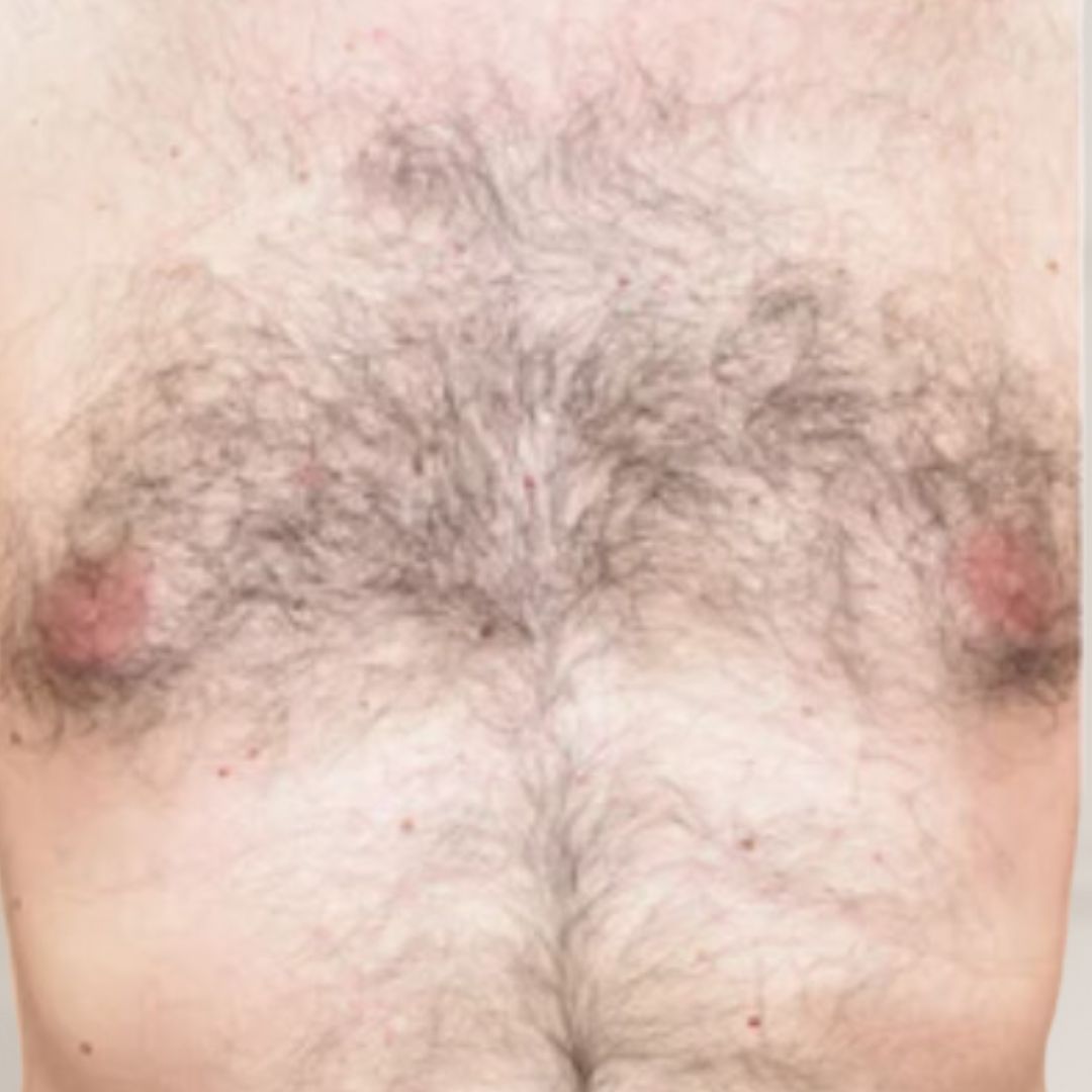 avant épilation définitive (5)