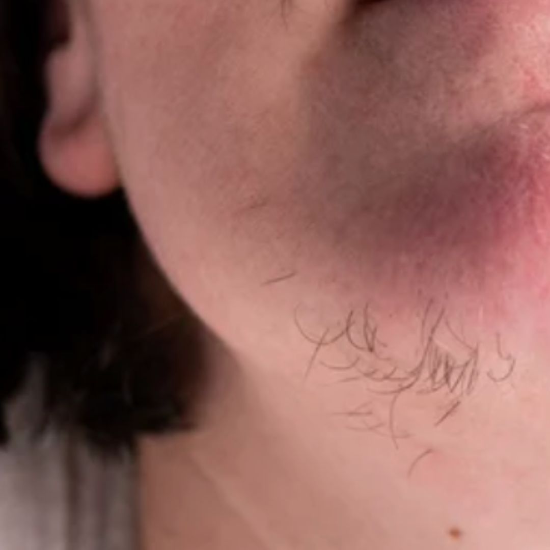 avant épilation définitive (6)