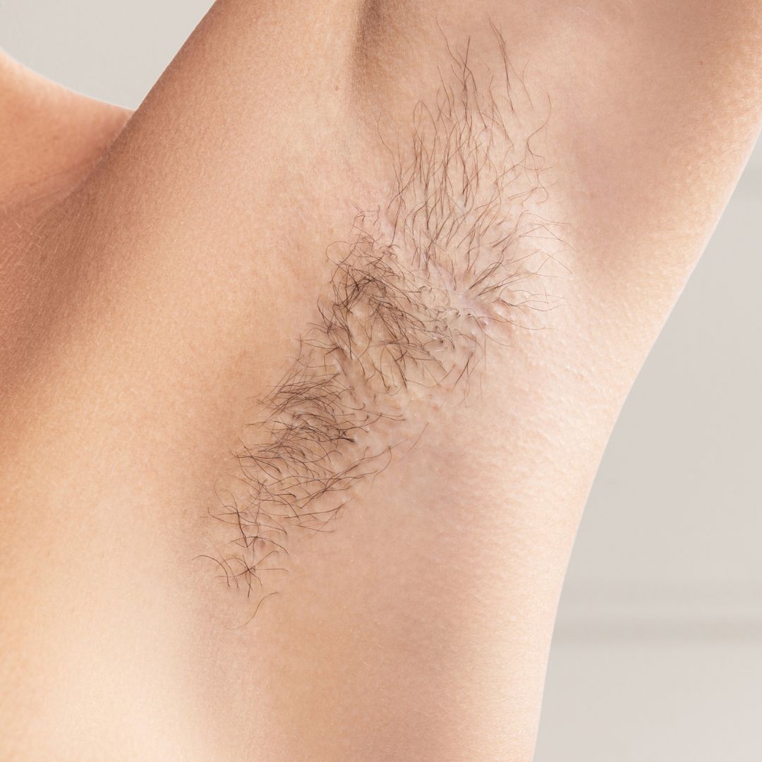 avant épilation définitive