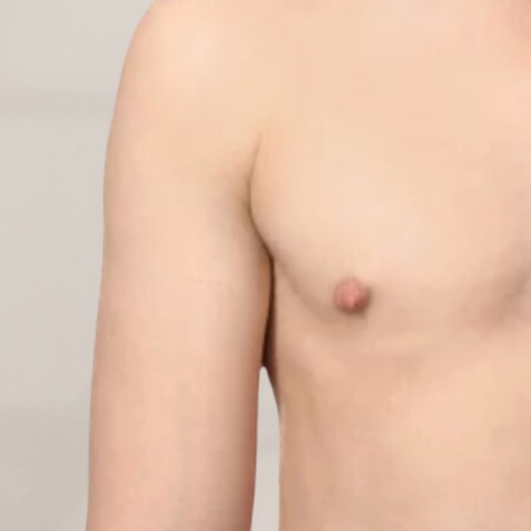 apres épilation définitive (10)