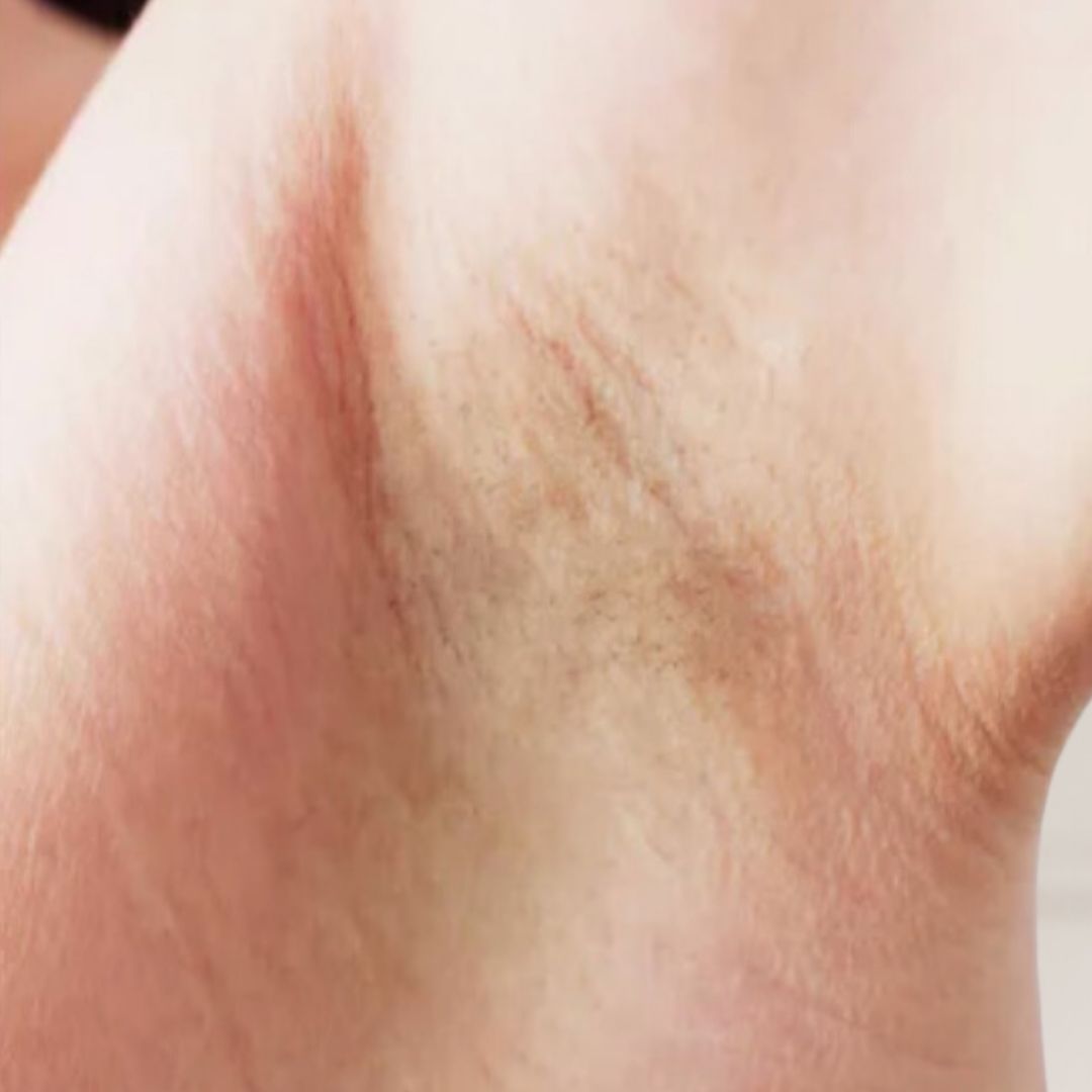 apres épilation définitive (11)