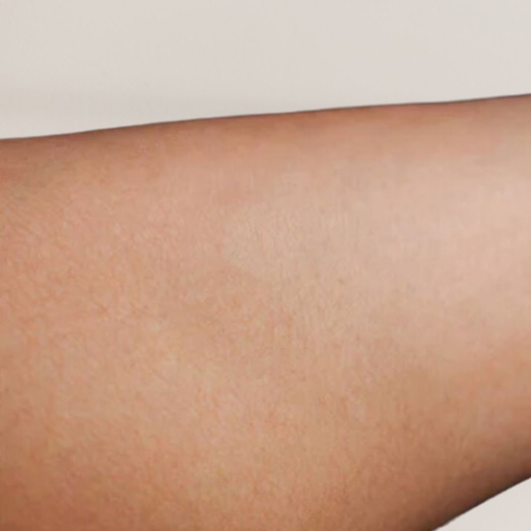 apres épilation définitive (19)