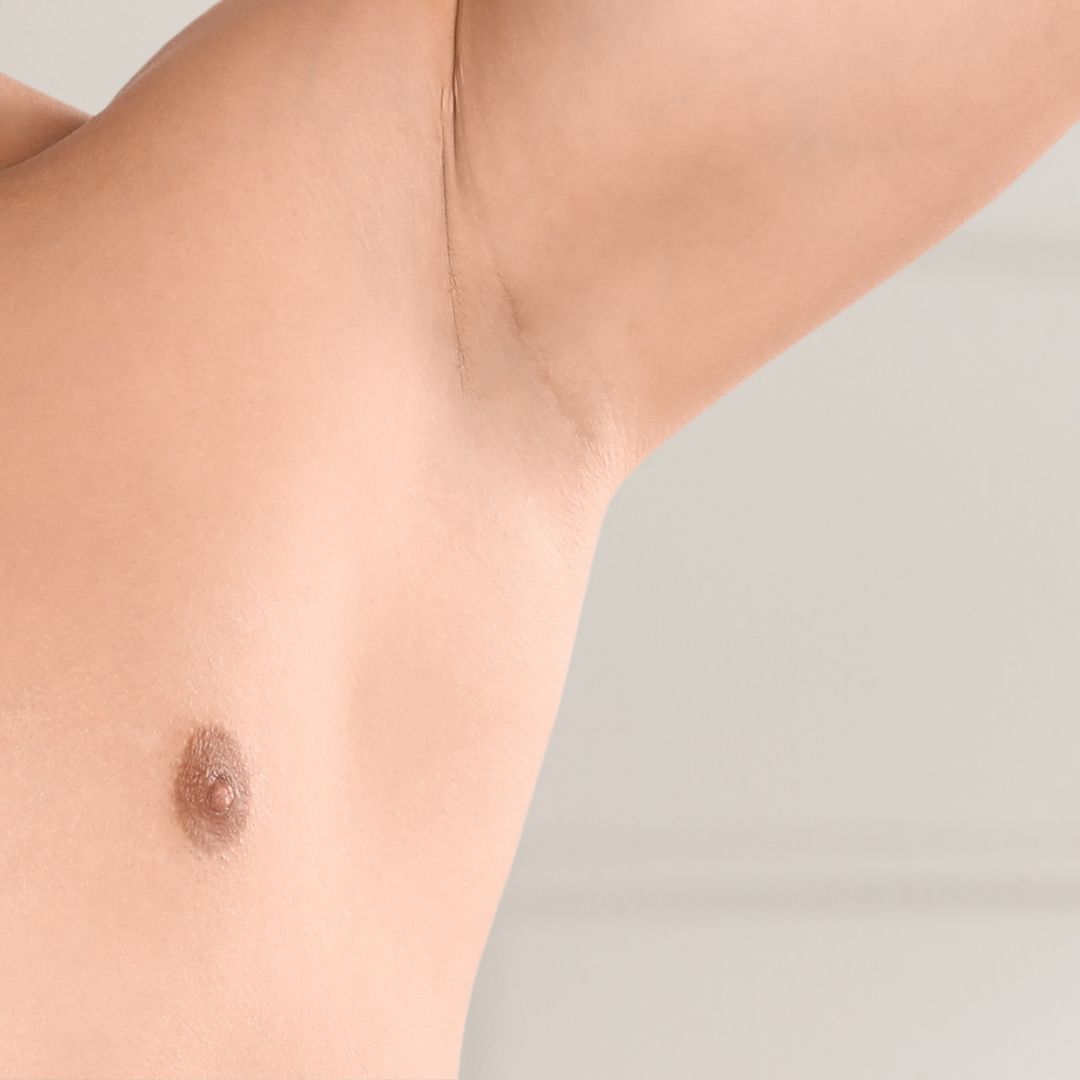 apres épilation définitive (2)