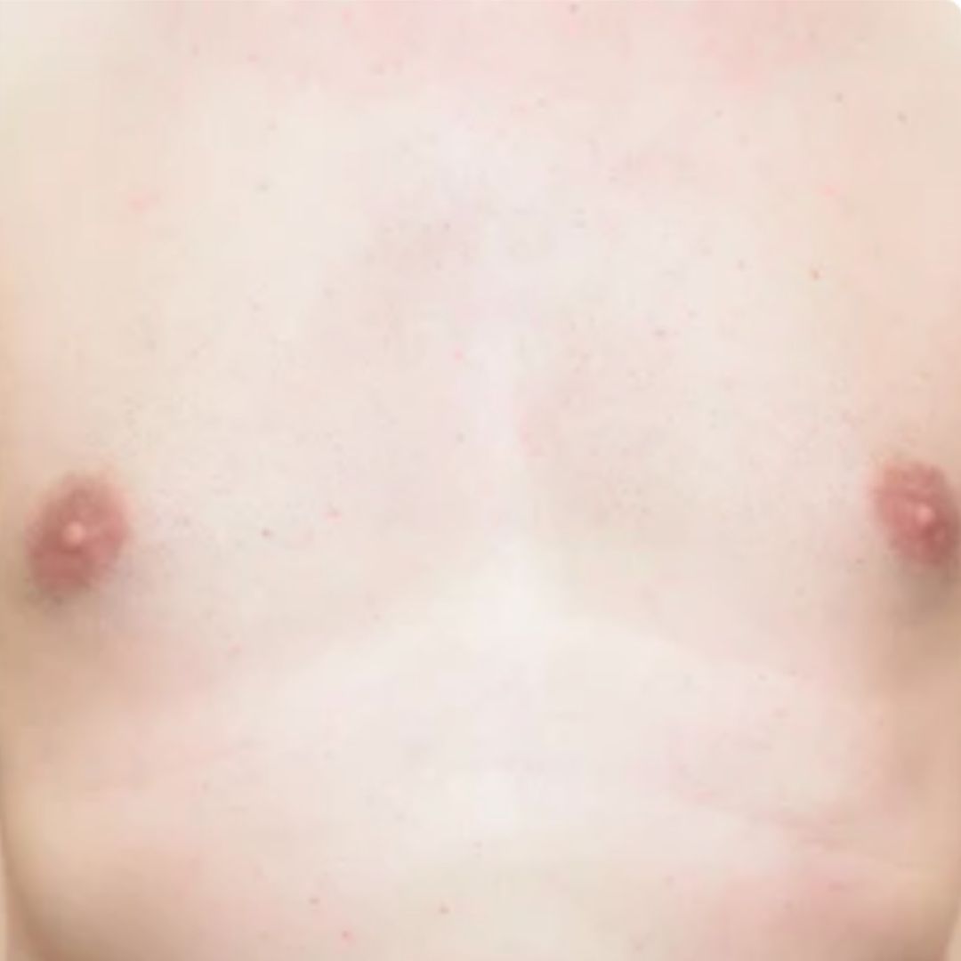 apres épilation définitive (5)