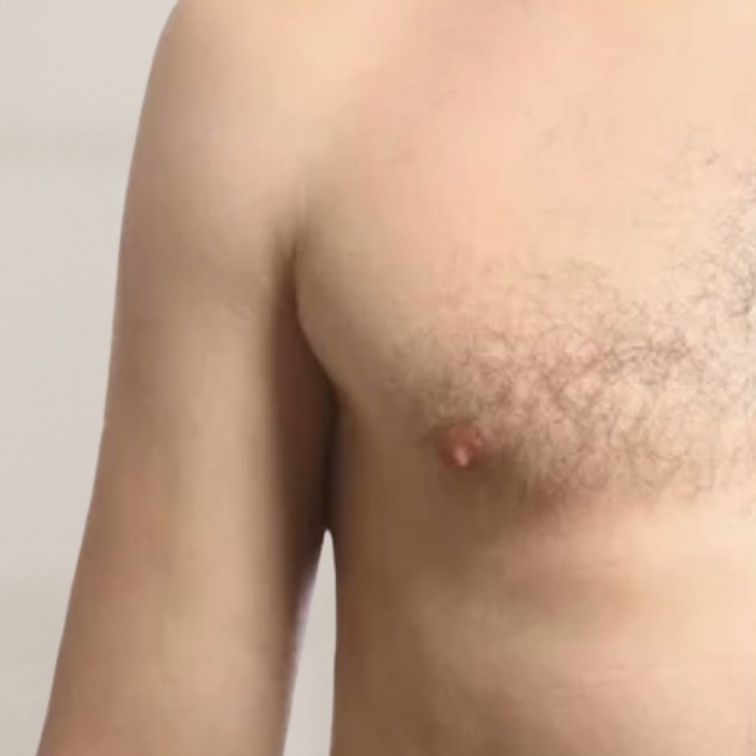 avant épilation définitive (10)