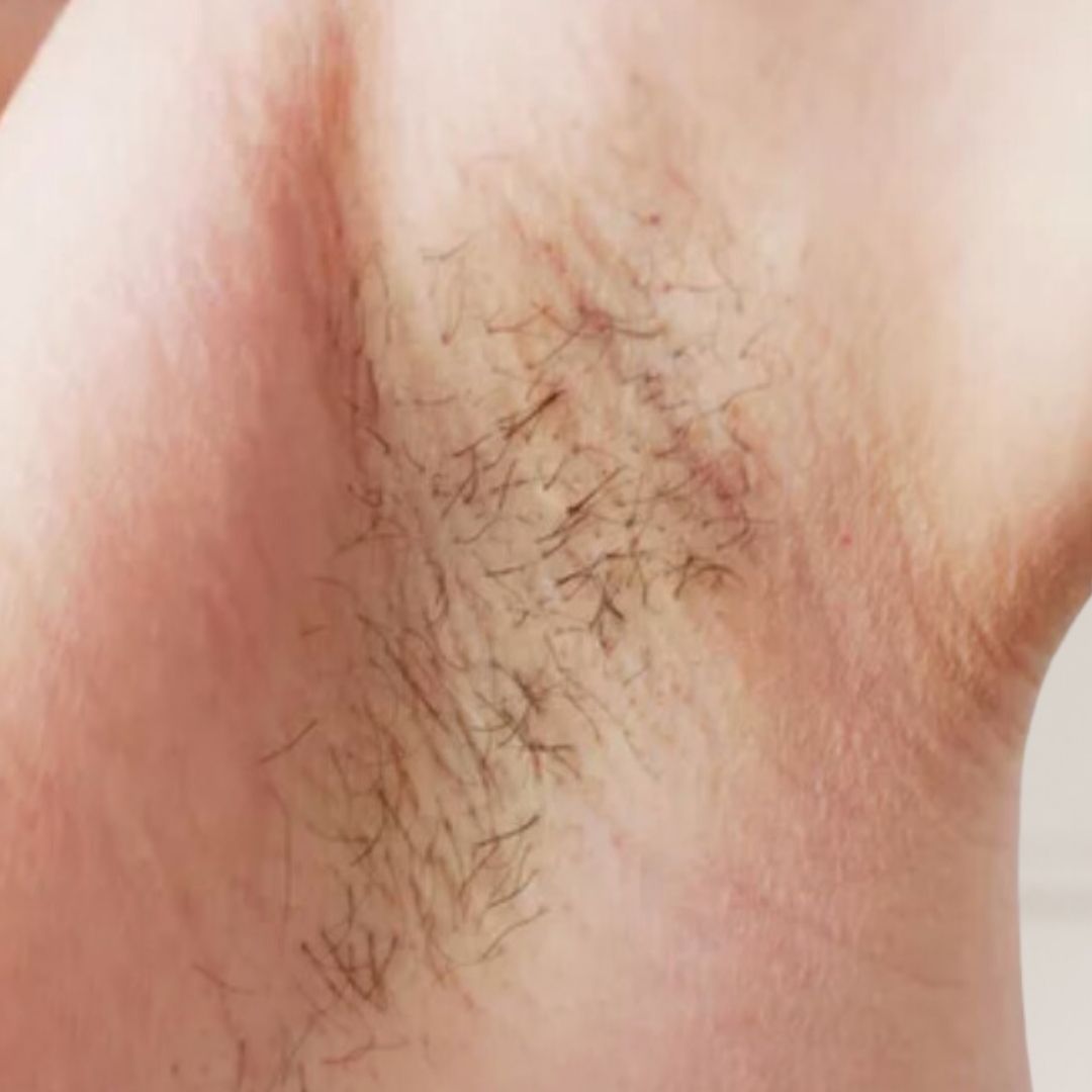 avant épilation définitive (13)