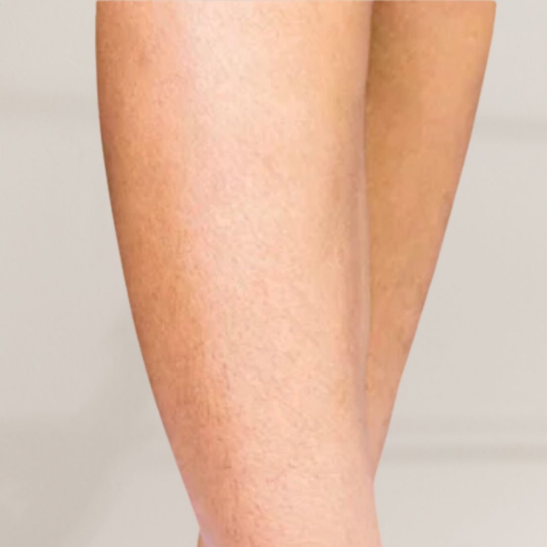 avant épilation définitive (17)