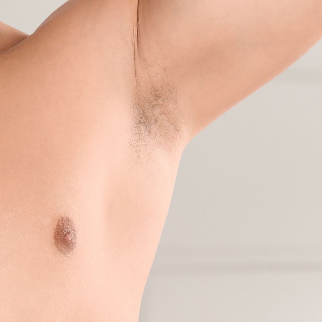 avant épilation définitive (2)