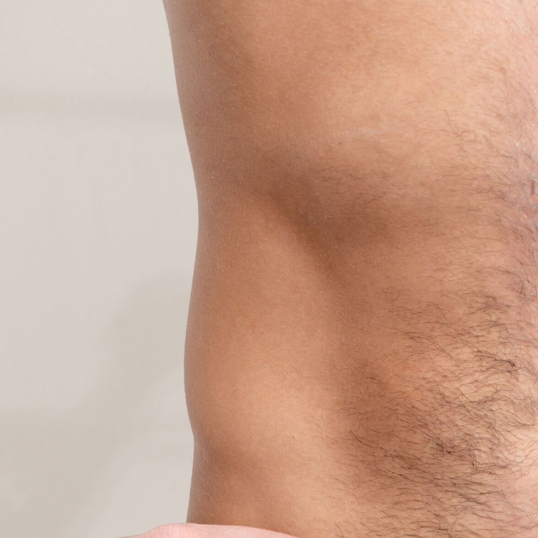 avant épilation définitive (2)