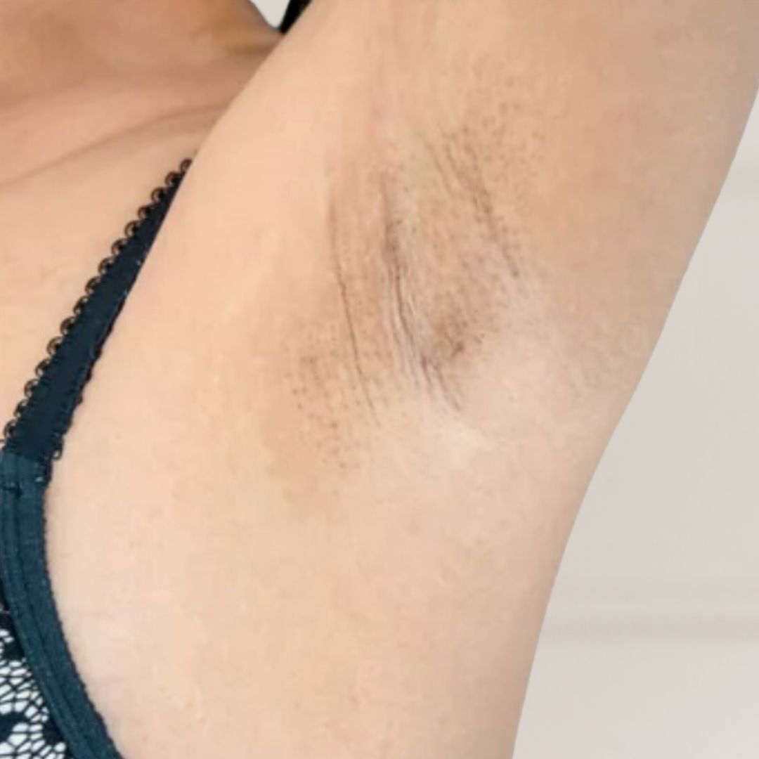 avant épilation définitive (2)