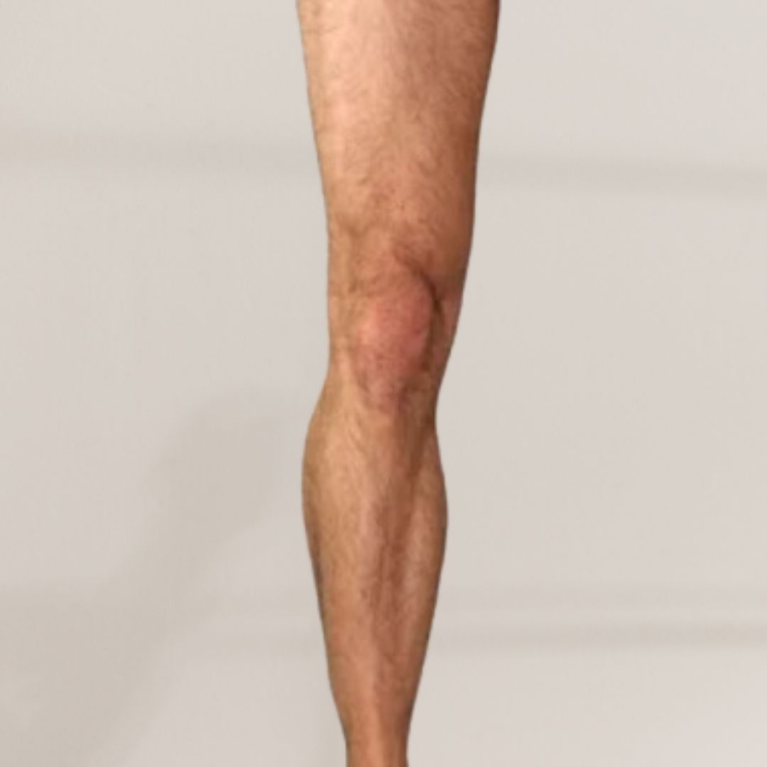 avant épilation définitive (20)