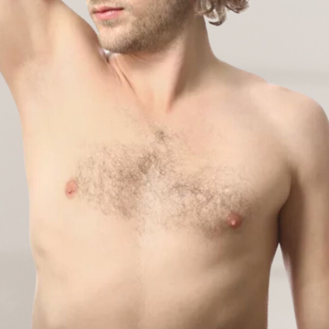 avant épilation définitive (25)