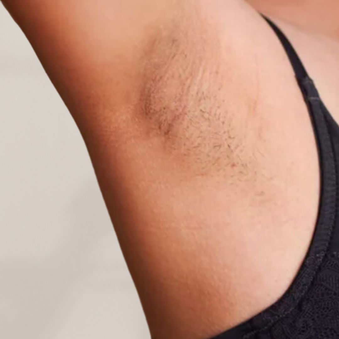 avant épilation définitive (3)