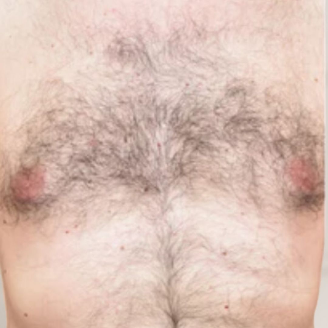 avant épilation définitive (5)