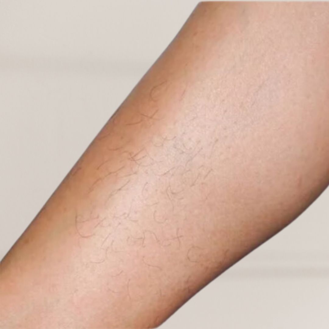 avant épilation définitive (9)