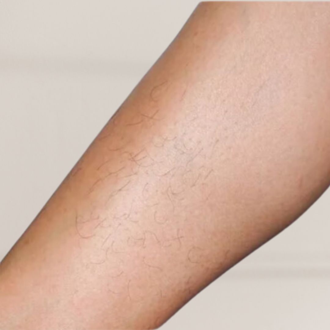 avant épilation définitive